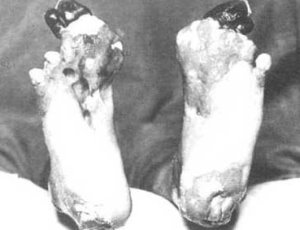 Trench Foot